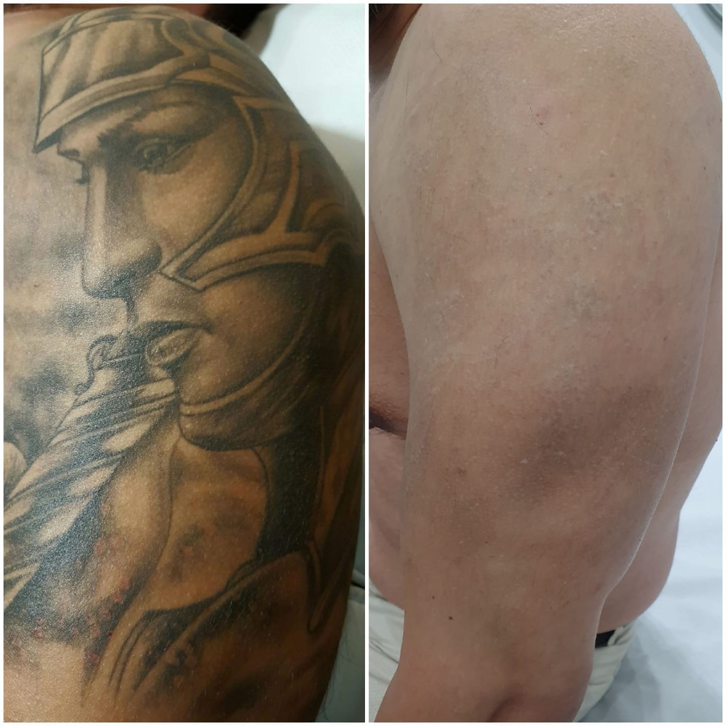 Laser Tattoo, Eliminación de Tatuajes en Madrid